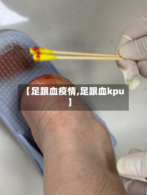 【足跟血疫情,足跟血kpu】